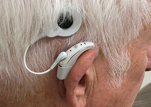 Closeup Of Dave Modrell's Cochlear Implant